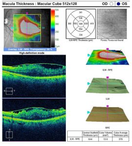 Epiretinal Membrane | Retina & Vitreous of LA