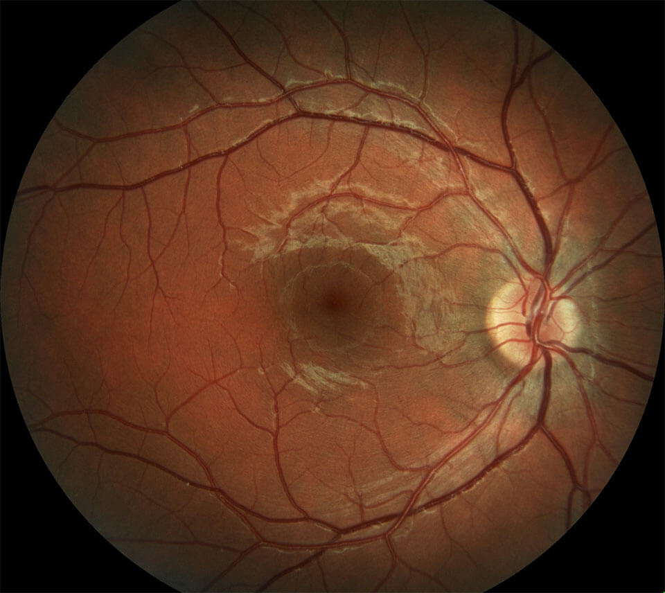 Normal fundus and angiogram photos 