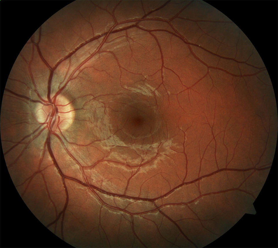 Normal fundus and angiogram photos 