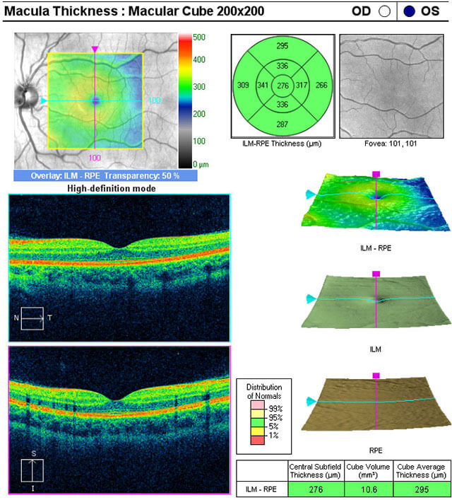 Normal Ocular Coherence Tomography scans