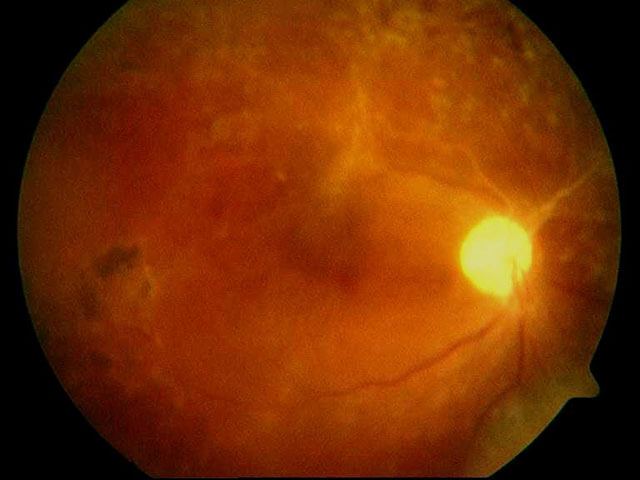 retinal detachment after repair