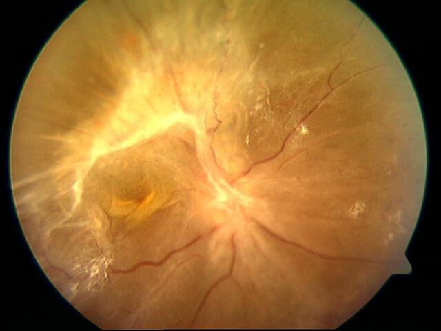 retinal detachment before repair