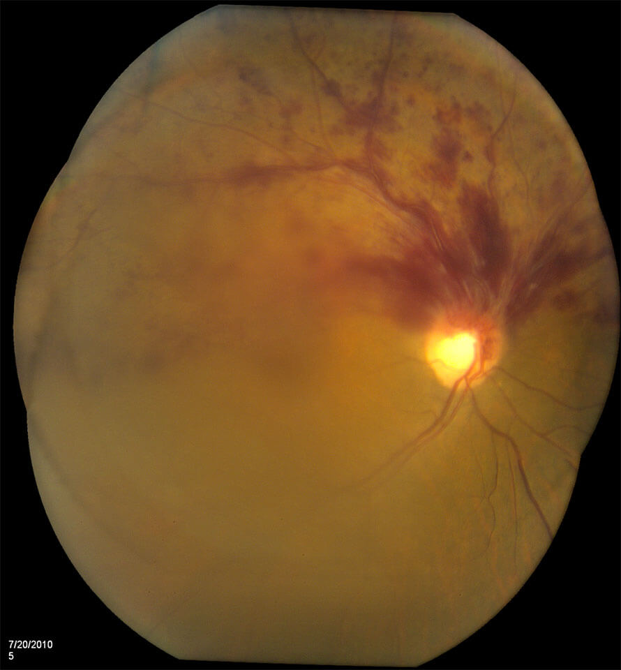 retinal vein occlusions