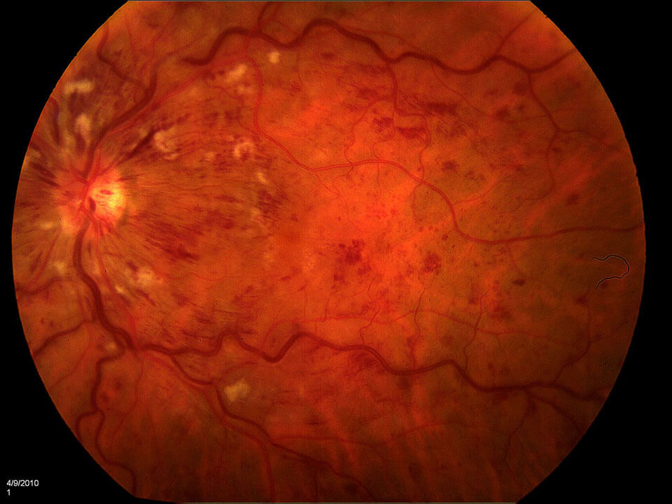 central retinal vein occlusion