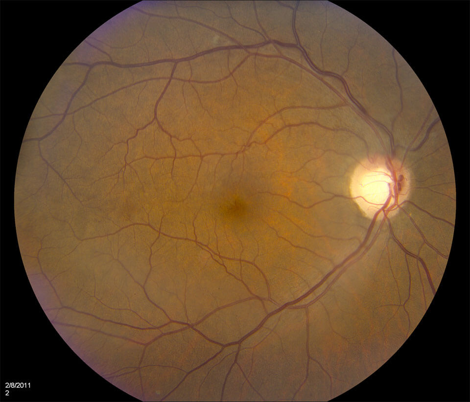 retina after treatment